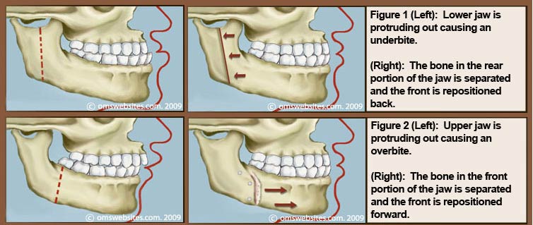 Orthognathic Surgery – Watermanomfs