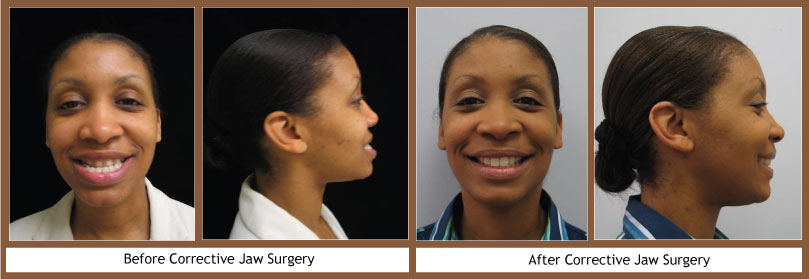 Corrective Jaw Surgery (Orthognathic)